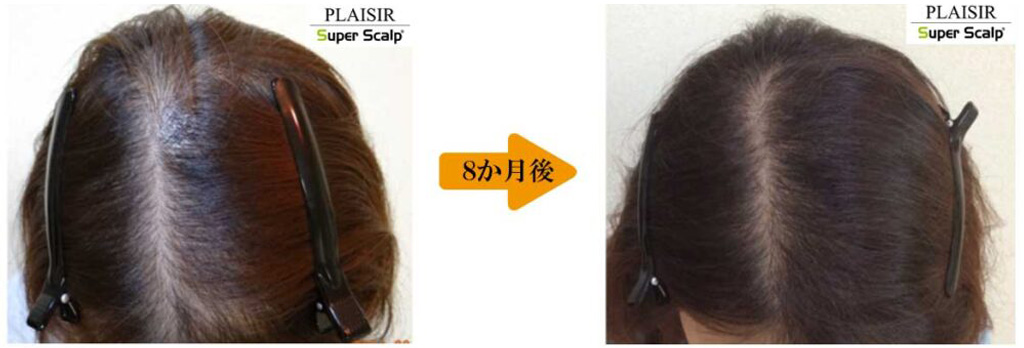 30代女性薄毛治療症例