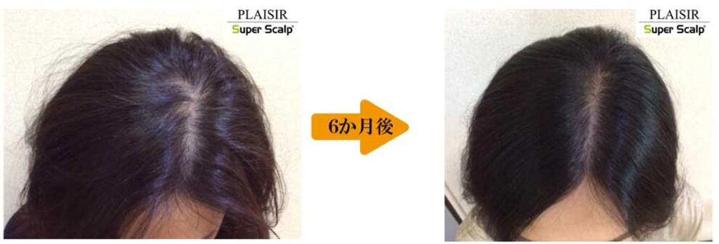 40代女性薄毛治療症例