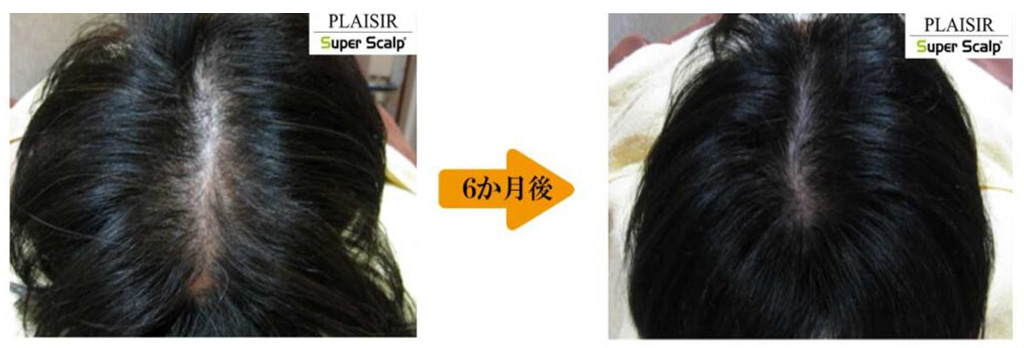 50代女性薄毛治療症例