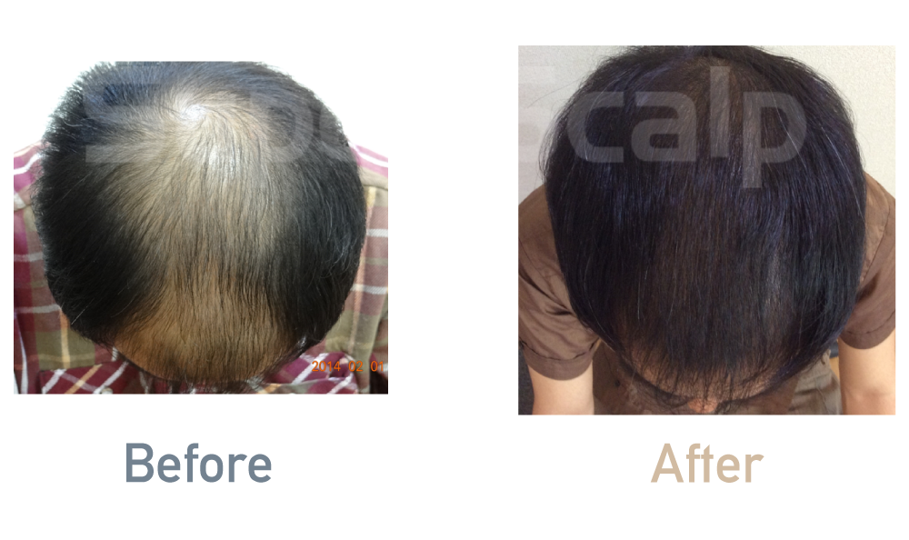 薄毛治療効果事例「40代男性」