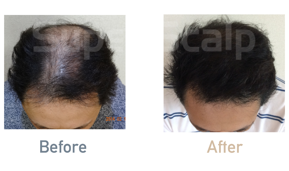 薄毛治療効果事例「30代男性」
