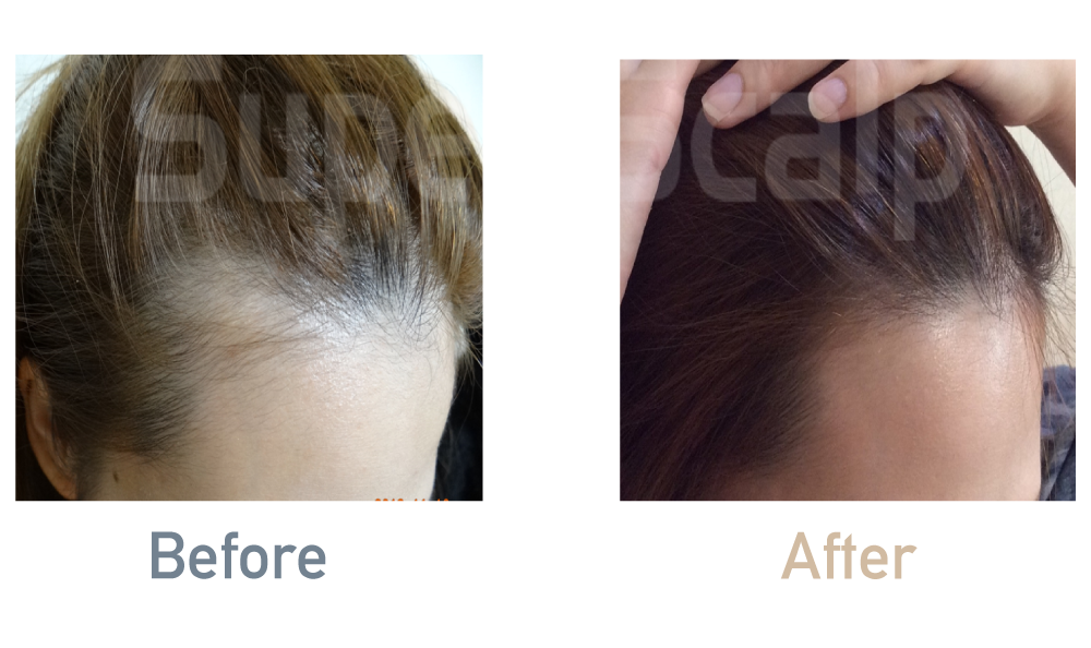 薄毛治療効果事例「20代女性」