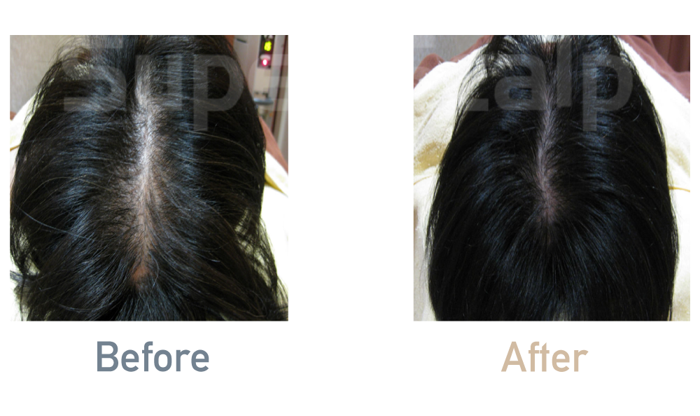 薄毛治療効果事例「50代女性」